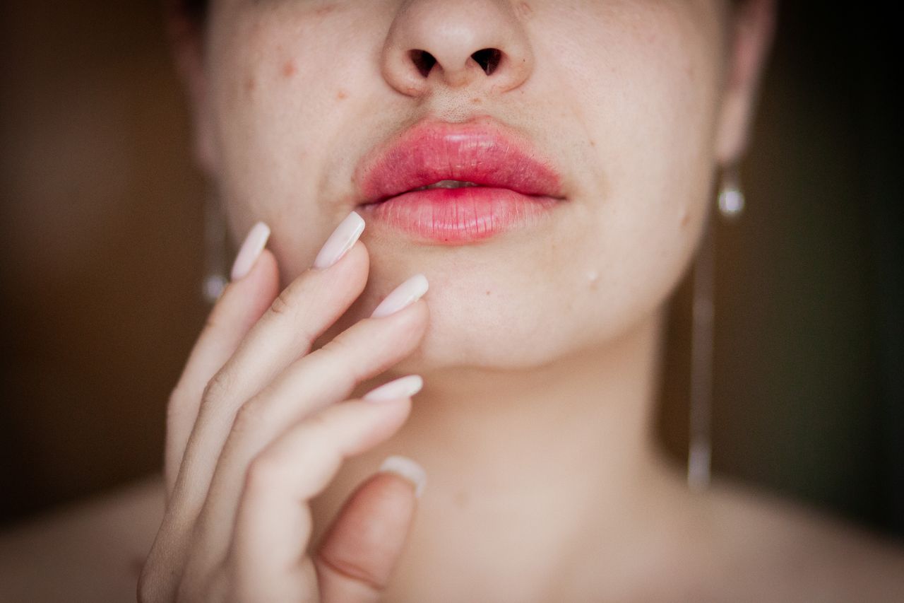 Melasma Treatment Is Changing, And The New Approach Looks Much Gentler